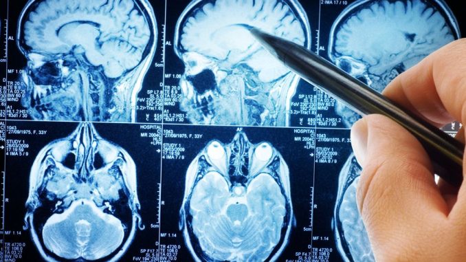 jedan-simptom-moze-ukazivati-na-tumor-mozga-javlja-se-pri-budenju